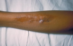 A salmonella lesion of the leg. Along with the advanced infection, the patient had sickle cell disease and osteochondrodystrophia. (Source: CDC)